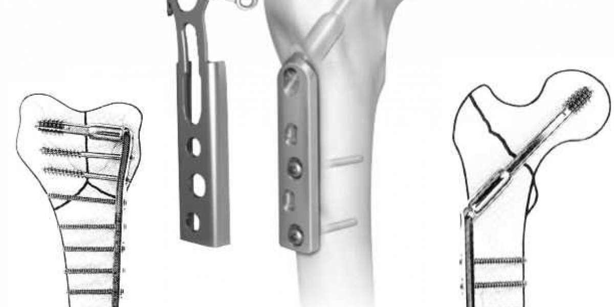 Orthopedic Implants Manufacturers