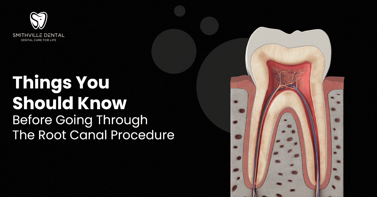 Things You Should Know Before Going Root Canal Procedure