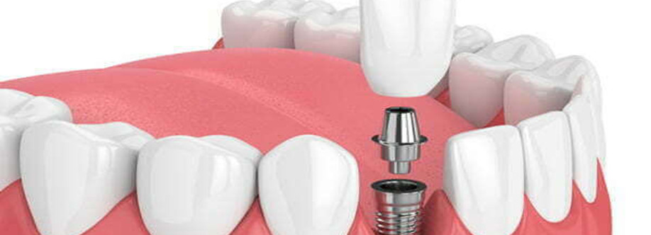 Guide to Dental Implants Cover Image